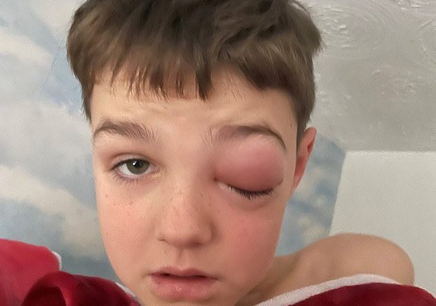 Zach Morey, de 9 anos, de Bristol, perdeu a visão do olho esquerdo menos de uma semana depois de ter testado positivo para o vírus e desenvolver celulite orbitária - uma infecção bacteriana da órbita ocular.