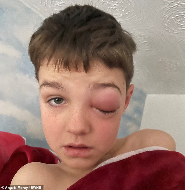 Zach Morey, de 9 anos, de Bristol, perdeu a visão do olho esquerdo menos de uma semana depois de ter testado positivo para o vírus e desenvolver celulite orbitária - uma infecção bacteriana da órbita ocular.