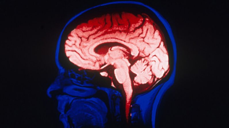 Estudo descobre que estudos de imagens cerebrais são prejudicados por pequenos conjuntos de dados