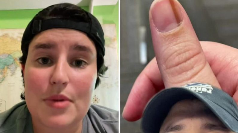 Sinais e sintomas de melanoma sublingual em uma mulher americana que notou uma 'linha fria' sob o polegar por 10 anos
