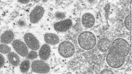 Os Centros de Controle e Prevenção de Doenças estão monitorando 6 pessoas nos EUA para possível varíola, mas dizem que o público não deve se preocupar.