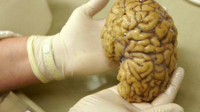 Brain Atlas: Pesquisa ambiciosa pode levar a uma nova compreensão sobre a demência