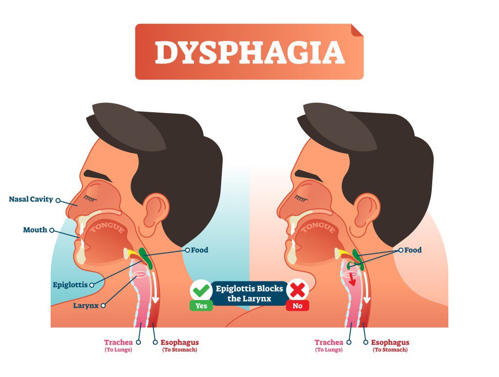 É mostrada uma ilustração da disfagia, um sintoma que pode ocorrer em pessoas com demência.